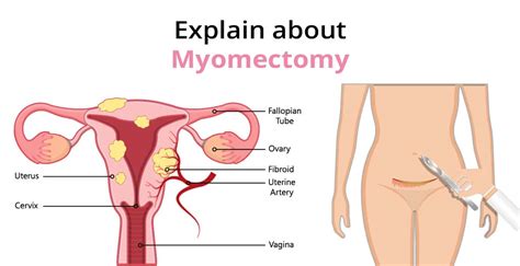 Myomectomy: Kinds, Risks & Preventions | Birla Fertility & IVF