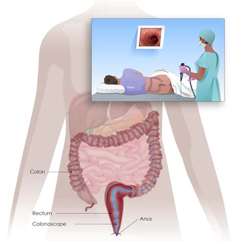 Colorectal Cancer - Screening and testing - Digestive Cancers Europe