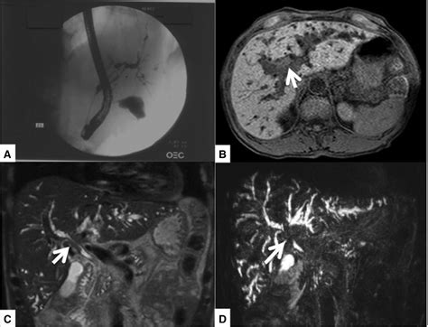 IgG4-related sclerosing cholangitis mimicking hilar cholangiocarcinoma ...