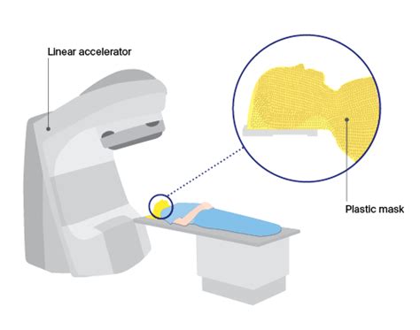 Having External Beam Radiation Therapy | Head and Neck Cancer | Cancer Council NSW