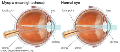 Nearsighted (Myopia)