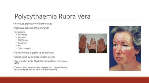 Polycythemia Vera: Symptoms, Causes, Diagnosis, and Treatment Options