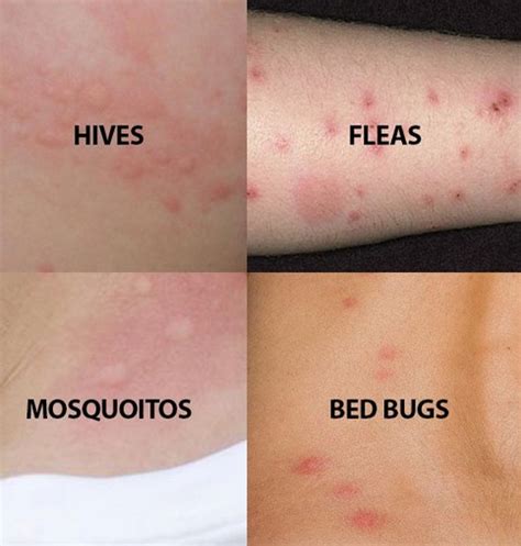 Bed Bug Bites How To Treat | Bed Bug Bites Treatment