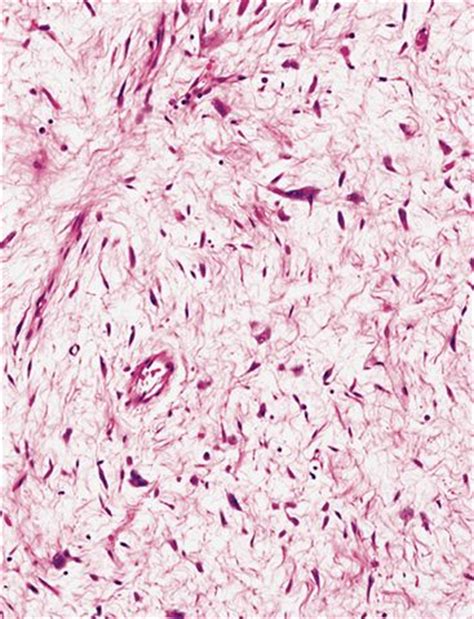 Pathology Outlines - Myxofibrosarcoma