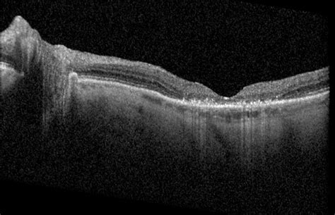 Plaquenil toxicity - Retina Image Bank