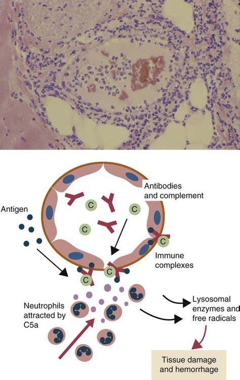 Immune Complexes and Type III Hypersensitivity | Veterian Key