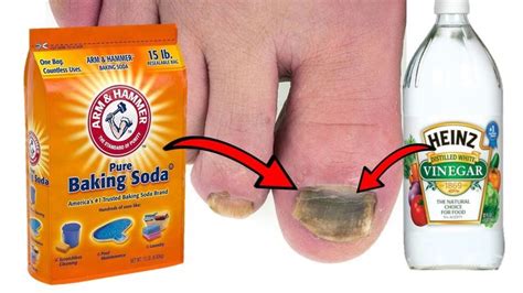 How To Get Rid of TOENAIL FUNGUS With Baking Soda & Vinegar - YouTube | Toenail fungus, Baking ...