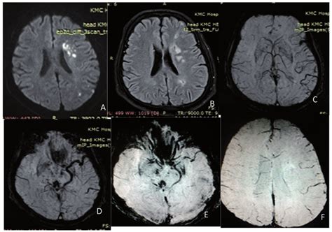 Patient with right hemiparesis. (a) Acute infarct in the left corona... | Download Scientific ...