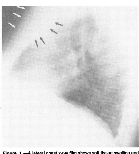 Figure 1 from Primary sternal osteomyelitis. | Semantic Scholar