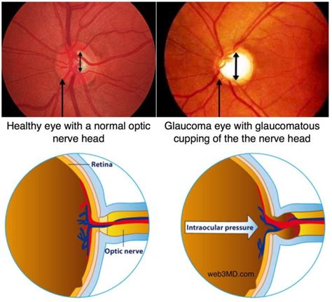 glaucoma-cupping-of-nerve-head-1024x932