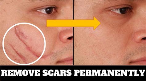 Use This and Permanently Remove Scars, Burn scars, Acne Scars and Surgical Scars - YouTube