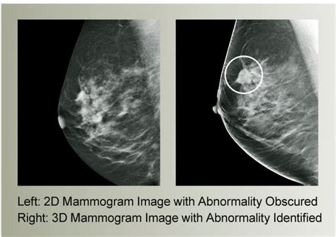 Get Screened: Why Women Should Have Annual Mammograms Starting at Age 40 | Lake Medical Imaging ...