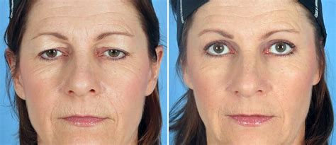 Why Eyelid Lift Surgery Consistently Tops the Charts (+ What it Can Do for You) - Swan Center ...