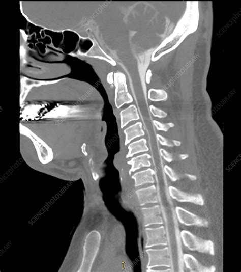 Cervical Myelogram CT - Stock Image - C027/1642 - Science Photo Library