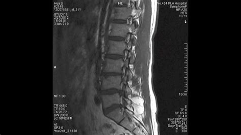 MRI L5-S1 Herniated Disc + Other Issues - YouTube