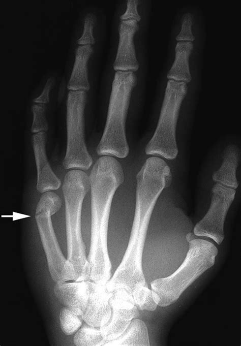 Hand Fractures - OrthoInfo - AAOS