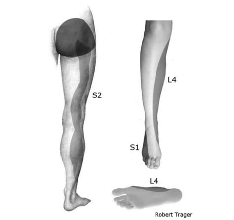 Superior cluneal nerve entrapment. Entrapment or compression of the ...