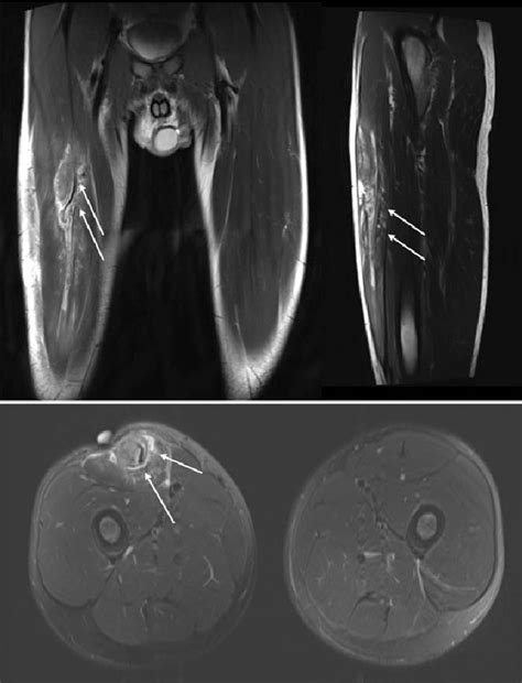 Figure 1 from Chronic and Recurrent Rectus Femoris Central Tendon ...