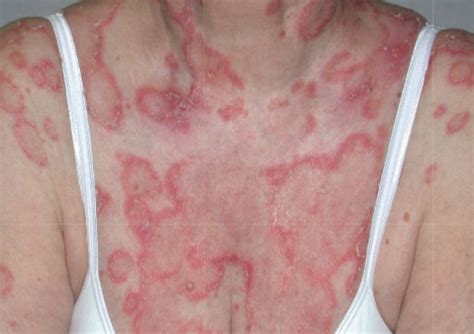 ACD A-Z of Skin - Cutaneous Lupus Erythematosus