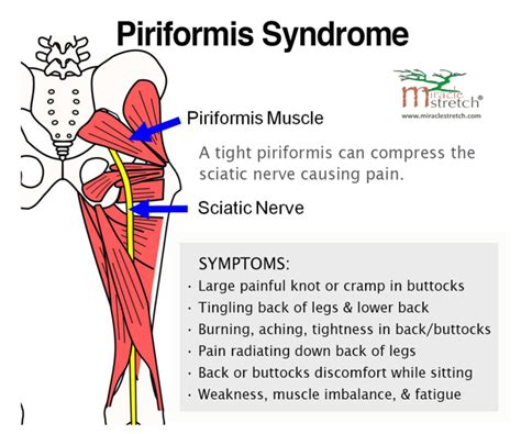 Piriformis Syndrome Massage Treatment - GG Physio