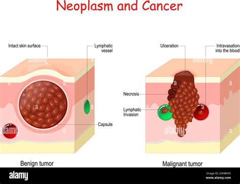 Neoplasm High Resolution Stock Photography and Images - Alamy