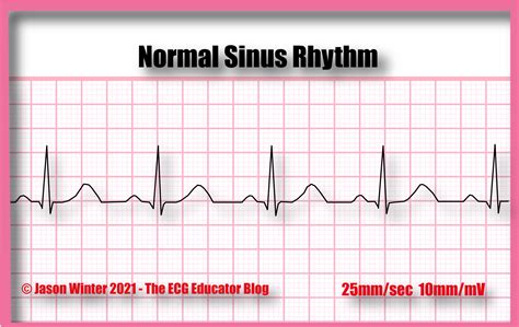 ECG Educator Blog : Normal Sinus Rhythm