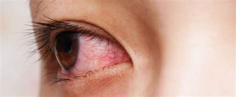 Most Common Eye Problems in India - Symptoms & Treatment Procedure