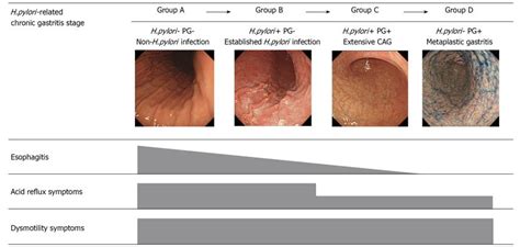 Assessment of gastroesophageal reflux disease by serodiagnosis of ...