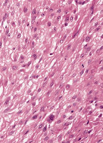 Pathology Outlines - Myositis ossificans