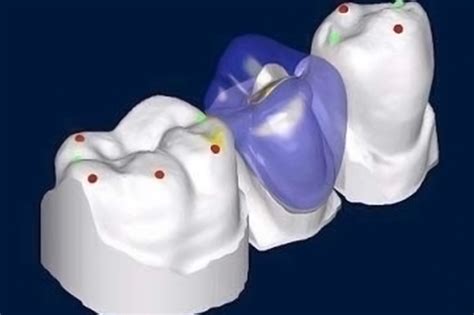 Cad Cam Technology for Crowns - Dental Home Clinic