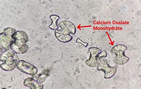 Microscopic image showing calcium oxalate monohydrate from urine ...