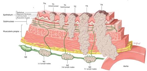 Stomach Cancer Stages