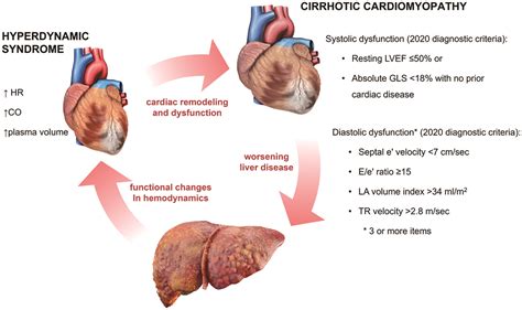 Cardiac Syndromes in Liver Disease: A Clinical Conundrum