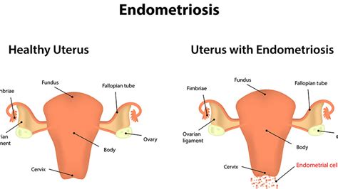 Cysts and Mild to Moderate Endometriosis