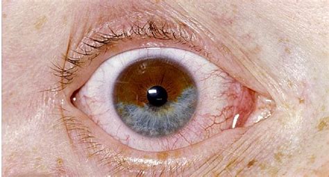 Pictures of Unusual Eye Conditions