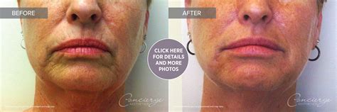 Before and After - Juvederm Ultra and Voluma (55 yo) | Concierge Aesthetics