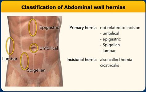 Ventral Hernia Ultrasound