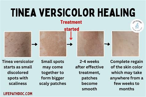 Tinea Versicolor: Healing Stages, Pictures, and Treatment