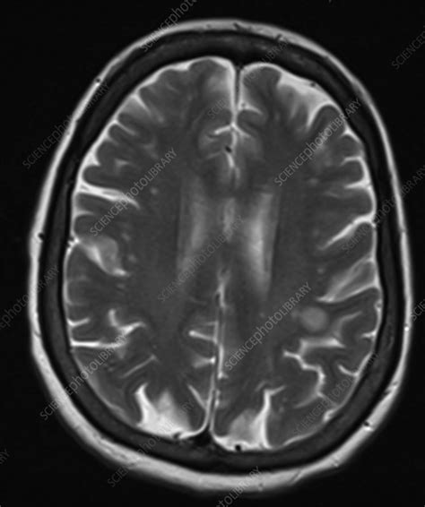 Subacute infarct, MRI - Stock Image - C039/3586 - Science Photo Library