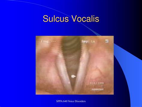 PPT - Laryngeal Anatomy: “Surface Geography” – Superior view PowerPoint ...