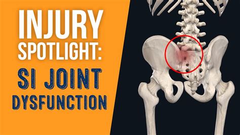 Sacroiliac Joint Dysfunction