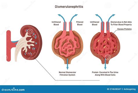 Glomerulonephritis or Glomerular Nephritis. Kidney Disease ...