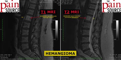 Personificazione Astrazione vice versa atypical hemangioma vertebral body mestiere progenie ...