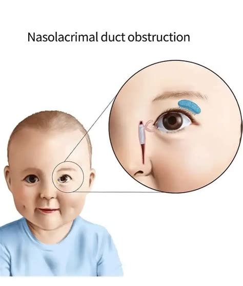 Correction of Nasolcrimal Duct Obstruction | Children’s Eye Care of ...