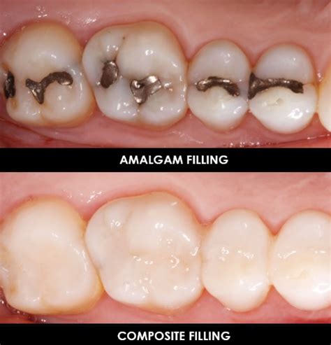 The Cost Breakdown Of Your Dental Fillings | Dentist Canberra