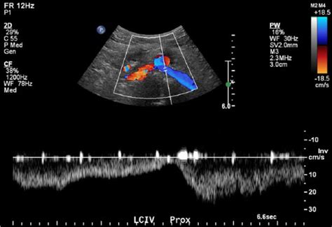 Sonography’s Role in the Diagnosis of May–Thurner Syndrome - Ashley Barry, 2018