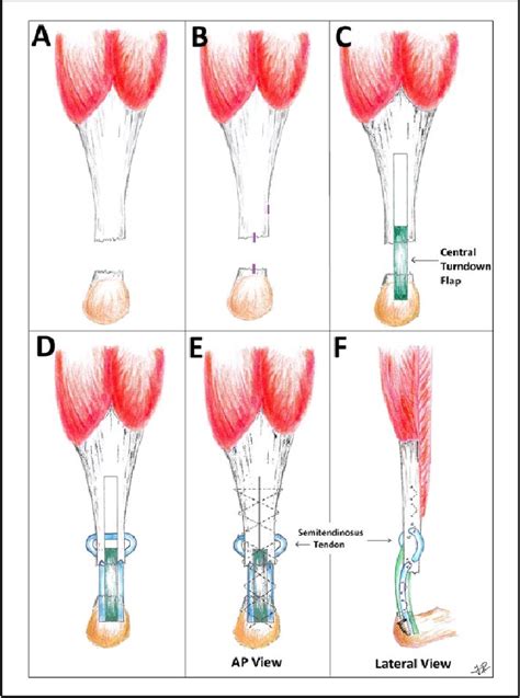 Endoscopy-Assisted Achilles Tendon Reconstruction With a Central ...