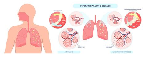 Asbestos Exposure Symptoms