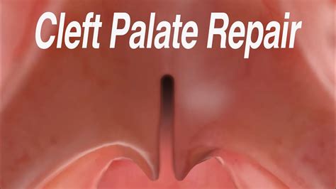 Cleft Palate Repair: Furlow Palatoplasty Technique - YouTube