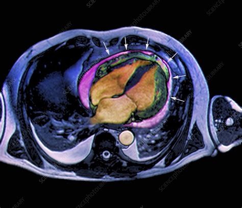 Fluid around heart in heart failure - Stock Image - C002/6463 - Science Photo Library